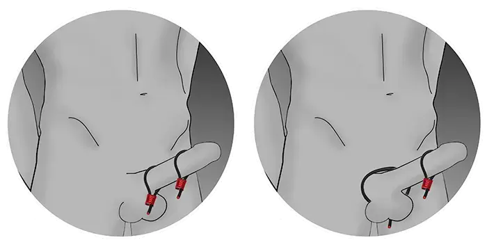 Prestige ElectraLoops regulējamais dzimumlocekļa gredzens – sarkans Foto 4