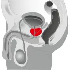 Prostatas masieris ar lodveida galvu un rievotu kātu – 20 cm (7.9″) — Foto 7